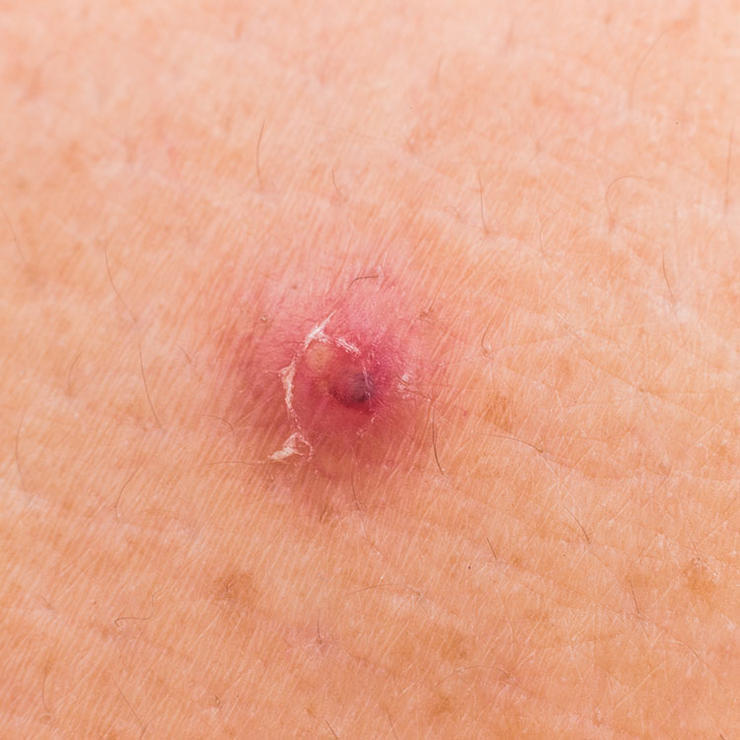 Cystic Acne
