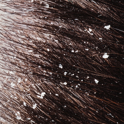 dandruff
